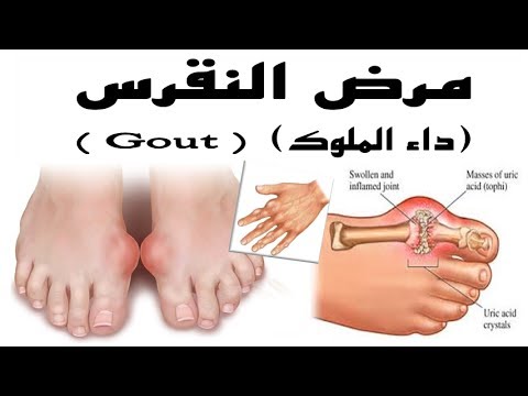 علاج النقرس نهائيا