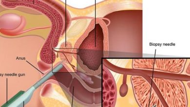 كيف يتم علاج البروستاتا ؟