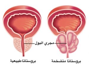 كيف يتم علاج البروستاتا ؟