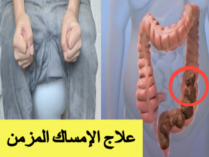 علاج الامساك المزمن