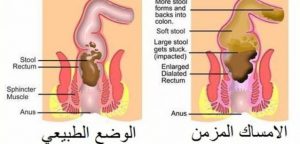 علاج الامساك المزمن