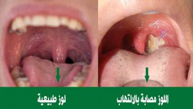 الأساليب المختلفة المتبعة لـ علاج التهاب الحلق واللوز