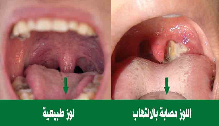 وجود قطع بيضاء صغيره في البول