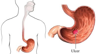 أساليب علاج قرحة المعدة طبيًا (دوائيًا) ومنزليًا (بـ الأعشاب)