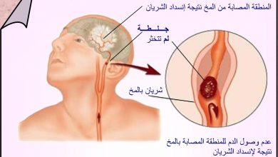 علاج جلطة المخ والأساليب المتبعة لـ الوقاية منها