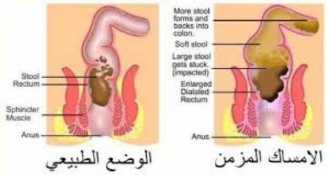 التخلص من الإمساك في ثلاث دقائق