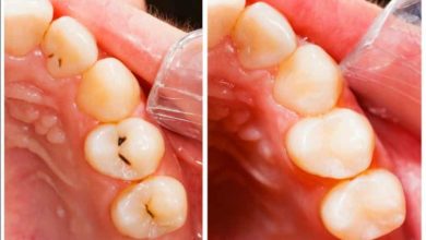 ما هي أساليب علاج تسوس الاسنان ؟