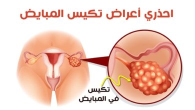 علاج تكيس المبايض بالاعشاب .. ما هي أبرز الخيارات ؟