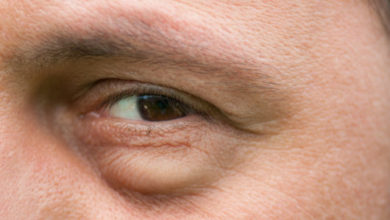 علاج انتفاخ تحت العين بـ طرق منزلية وطرق دوائية