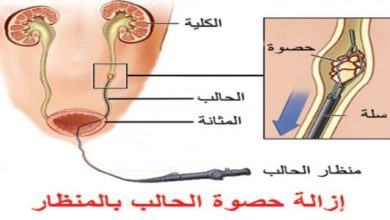 علاج حصوة الحالب ما بين علاجات منزلية وأدوية وتدخل جراحي