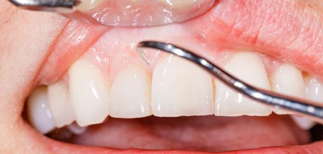 علاج تورم اللثة