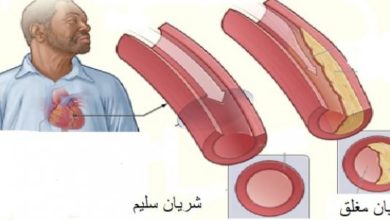 علاج تصلب الشرايين ما بين خيارات علاجية منزلية وخيارات علاجية دوائية