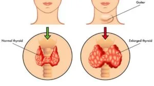 علاج نشاط الغدة الدرقية علاج نشاط الغدة الدرقية .. ما الذي يؤدي لـ فرط نشاد الدرقية ؟