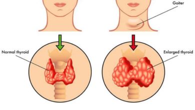 علاج نشاط الغدة الدرقية .. ما الذي يؤدي لـ فرط نشاد الدرقية ؟