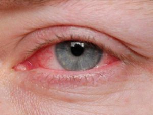 دواء كورنيريجيل Corneregel معقم ومطهر لـ العين ومضاد لـ القرحة العينية