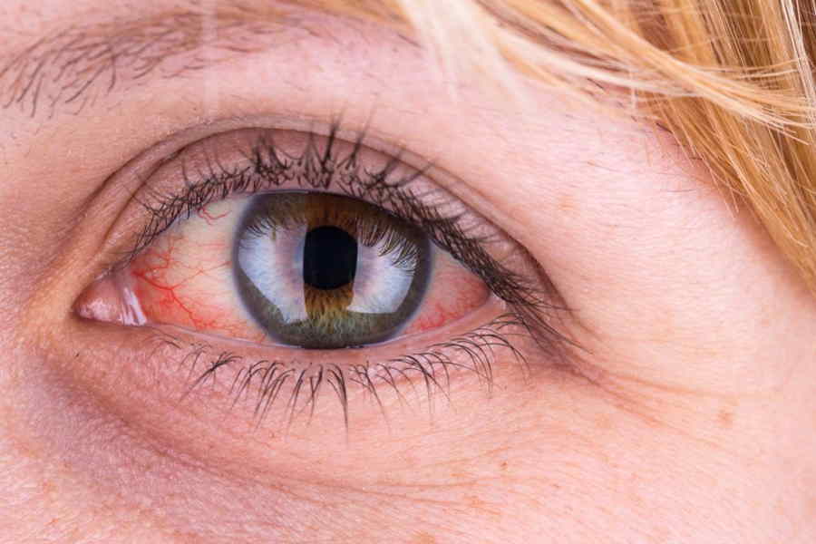 قطرة / نقط أوركازيد Orchazid مضاد لـ التهابات العين