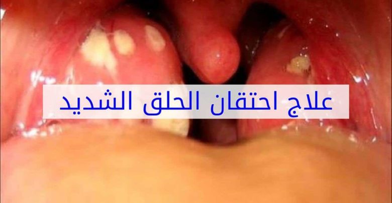 علاج احتقان الحلق الشديد