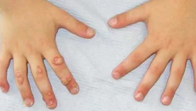 علاج السنط ما بين أساليب علاجية منزلية وأساليب علاجية دوائية