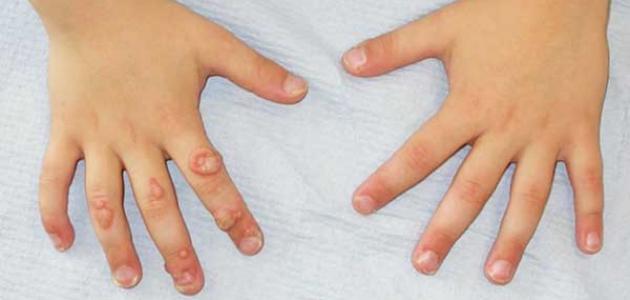 علاج السنط