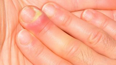 علاج الاصبع المدوحس ما بين أساليب علاجية منزلية وأساليب علاجية دوائية وطرق الوقاية