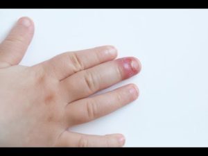 علاج الاصبع المدوحس ما بين أساليب علاجية منزلية وأساليب علاجية دوائية وطرق الوقاية