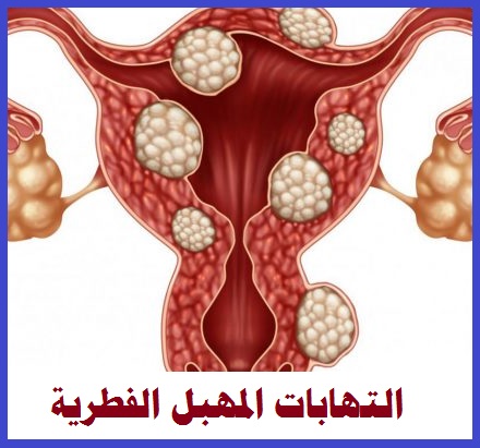 علاج الالتهابات المهبلية الفطرية والبكتيرية ما بين خيارات علاج منزلية وخيارات علاج دوائية