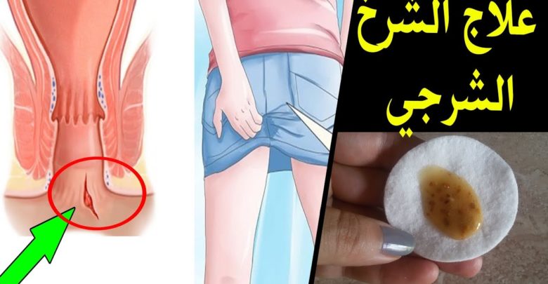 علاج الشرخ الشرجى