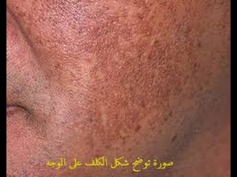 علاج الكلف