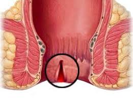 علاج الشرخ الشرجى ما بين أساليب علاجية منزلية وطبيعية وأساليب علاجية طبية ودوائية