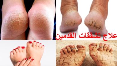 كريم بيكو فوت Pico Foot Cream لـ علاج حالات تشقق القدمين