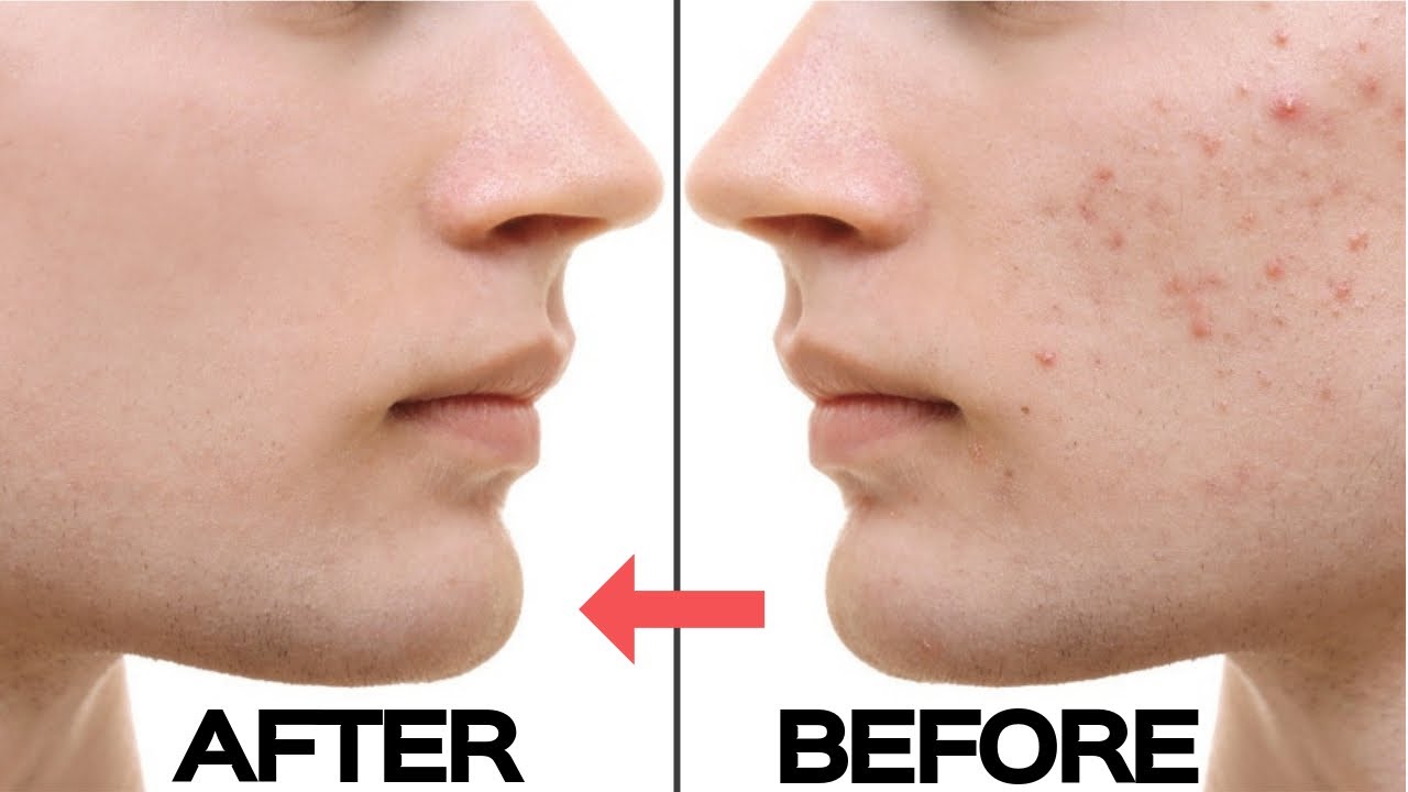 غسول وكريم أكني ستوب Acne Stop لـ التخلص من حب الشباب بـ شكل نهائي