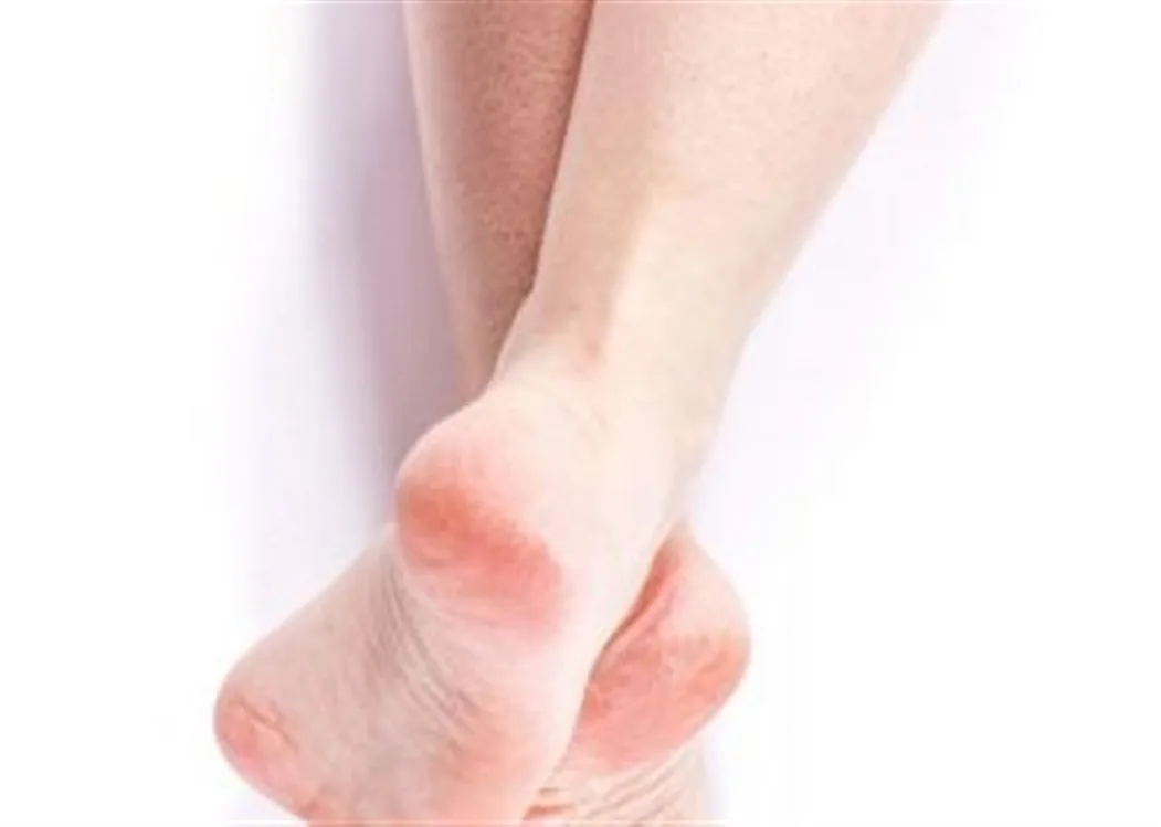 كريم بيكو فوت Pico Foot Cream لـ علاج حالات تشقق القدمين