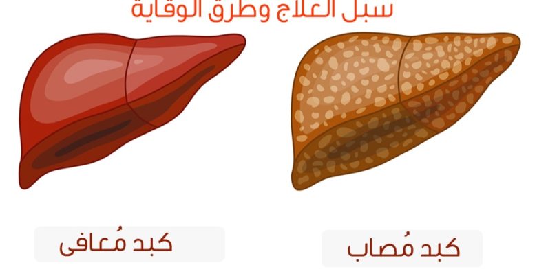 سبل العلاج وطرق الوقاية من دهون الكبد