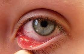 علاج دمل العين وأسبابه وكيفية الوقاية منه
