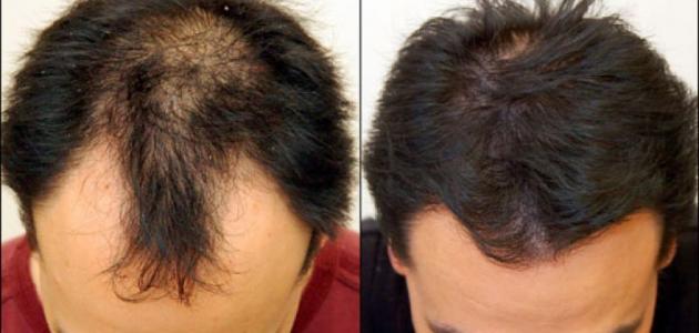 علاج تساقط الشعر للرجال 