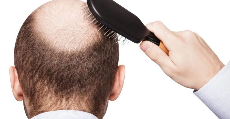 علاج تساقط الشعر للرجال