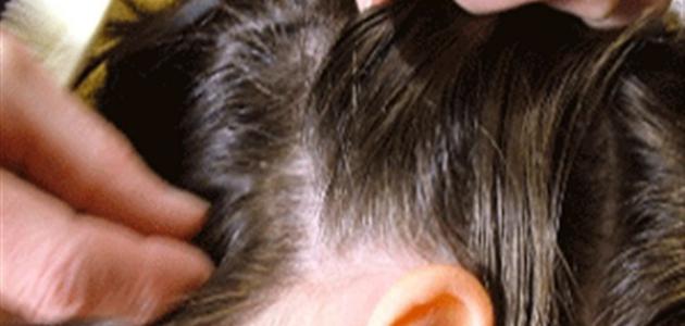 علاج حشرات الشعر بـ طرق سريعة وفعالة ومجربة