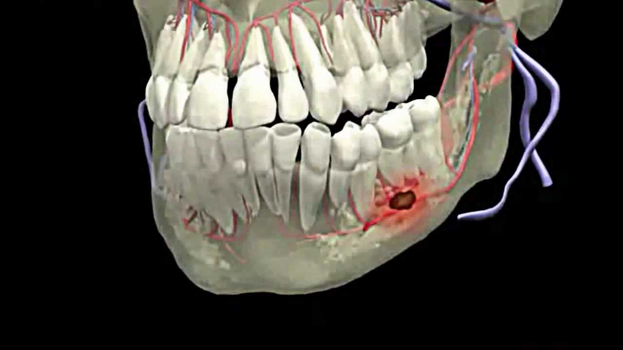 علاج خراج الأسنان