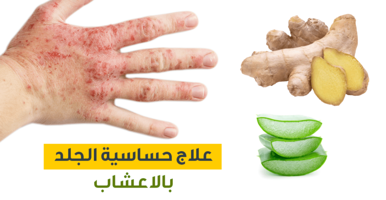 علاج حساسيه الجلد عند الاطفال