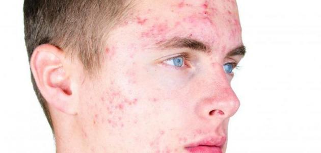 PIXIE ACNE بيكسي اكني