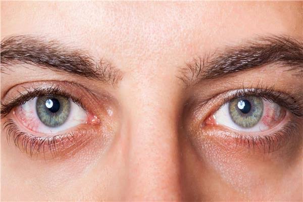 جفاف العين يسبب التهابها