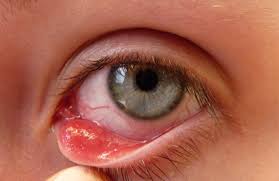 ظهور دمل العين في داخل جفن العين