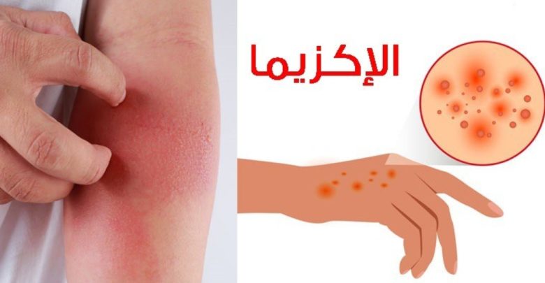 علاج الاكزيما