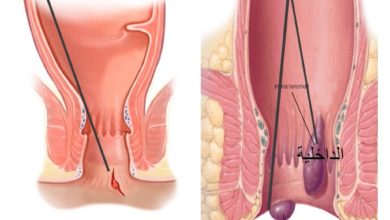 علاج البواسير بالاعشاب والأدوية بعيدًا عن الخيار الجراحي