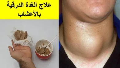 علاج الغدة الدرقية بالاعشاب