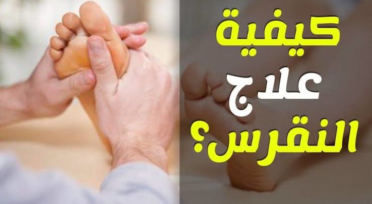 علاج النقرس مجرب