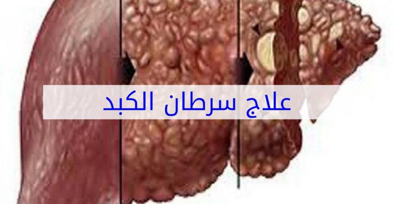 علاج سرطان الكبد