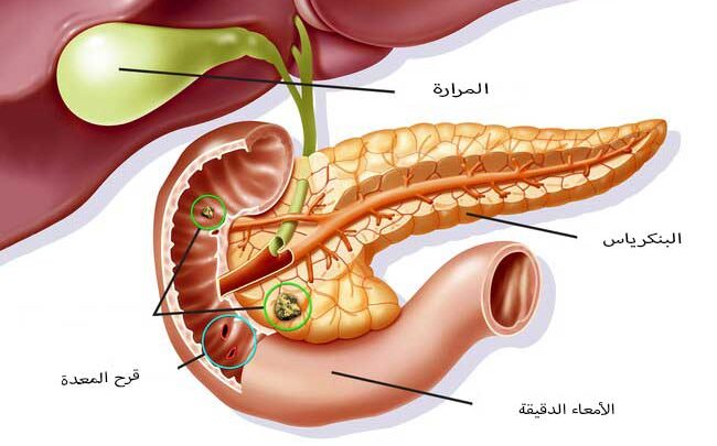 علاج فعال لقرحة المعدة