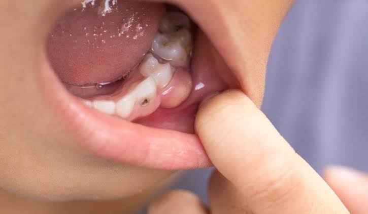 علاج خراج الأسنان بالمضاد الحيوي ونصائح للوقاية
