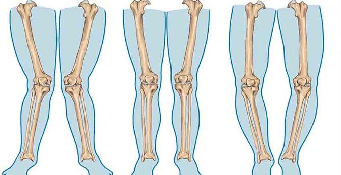 علاج تقوس الساقين